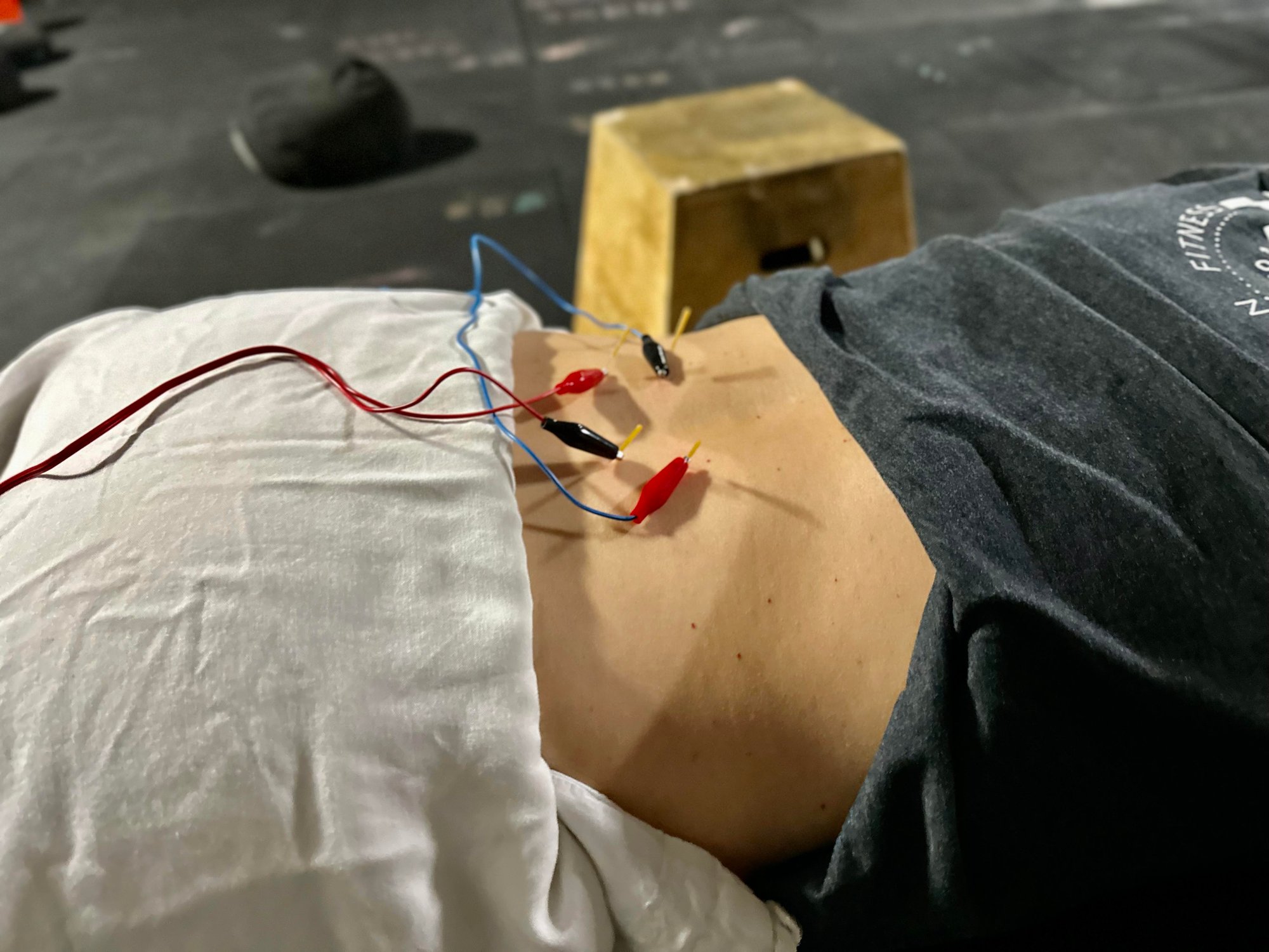 dry needling, Benjamin Burke,   Renew Physical Therapy, Oklahoma, City, OK